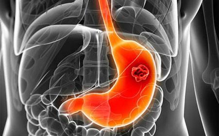 海外醫(yī)療，80%的患者檢查確診為胃癌中晚期，十類人需警惕胃癌