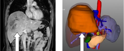 赴非洲工作竟身患肝癌絕癥“三名工程”國(guó)家隊(duì)出擊再燃重生希望