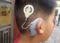 第五批國家組織高值醫(yī)用耗材集采開標(biāo) 人工耳蝸單套平均價(jià)格降至5萬元左右