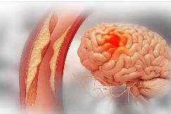 腦血管病藥械研發(fā)北京市重點(diǎn)實(shí)驗(yàn)室成立