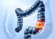 人工合成菌群有望緩解結(jié)直腸癌