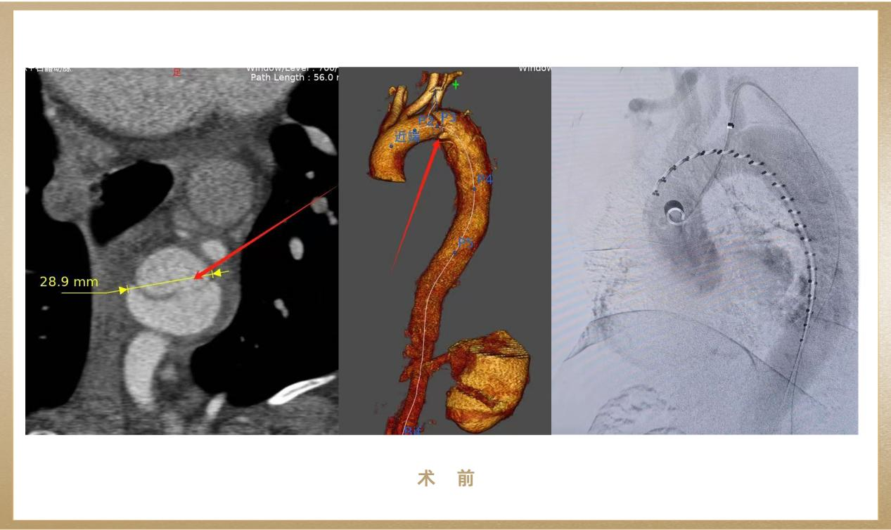 世界屋脊上的生命新高度！先健助力西藏阿里首例原位開窗胸主動(dòng)脈腔內(nèi)隔絕術(shù)