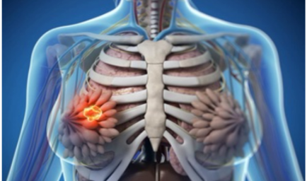 乳腺癌現(xiàn)“年輕化”趨勢(shì)　早篩早診早治是關(guān)鍵