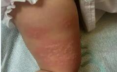 專(zhuān)家提醒：多重因素導(dǎo)致孩子過(guò)敏越來(lái)越常見(jiàn)