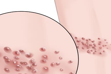 2026帶狀皰疹行動(dòng)月：多方共倡“三高一疹”聯(lián)防