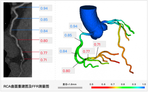 心臟的血管堵了，一定需要放支架嗎？